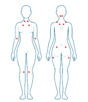 puntos dolorosos fibromialgia